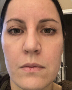 Stephanie A. after treatment