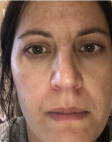 Stephanie A. before treatment
