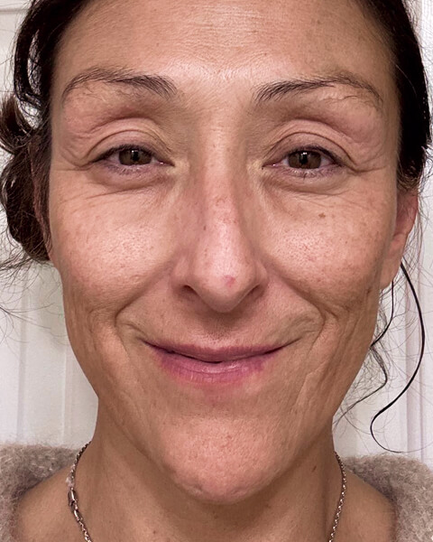 Tanya S. before treatment