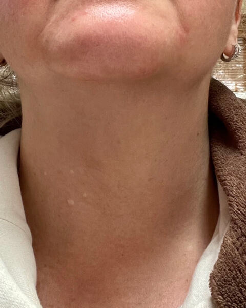 Tatyana P after treatment
