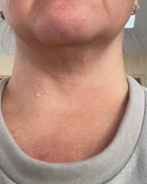 Tatyana P before treatment