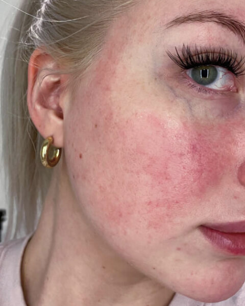 Taylor-Nicole L. before treatment