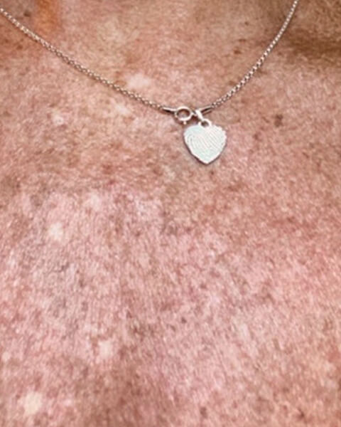 Tracy P. before treatment