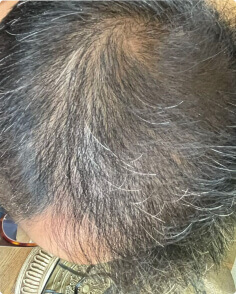 Wilson L. after treatment