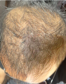 Wilson L. before treatment