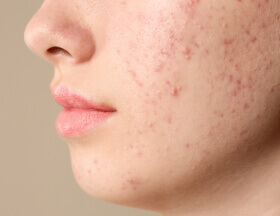 Acne (Face)