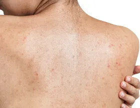 Acne Scars (Body)