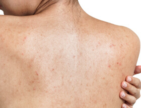 Acne Scars (Body)