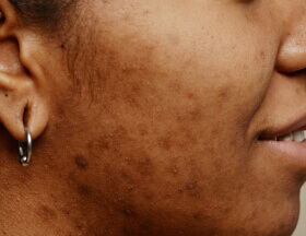 Acne Scars (Face)