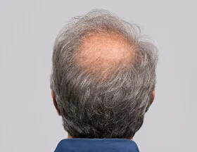 Bald Spots (Men)