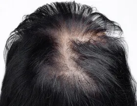 Bald Spots (Women)