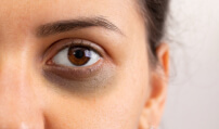 Dark Circles