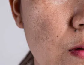 Dull Skin