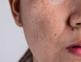 Dull Skin