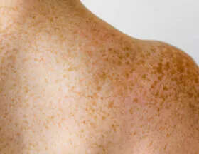 Freckles (Body)
