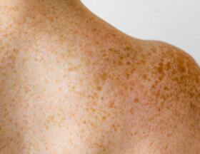 Freckles (Body)