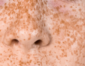 Freckles (Face)