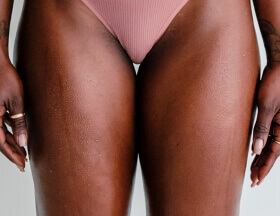Inner Thigh Dark Spots