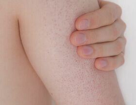 Keratosis Pilaris (KP)