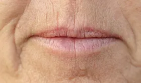 Lip Lines