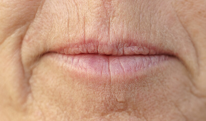 Lip Lines