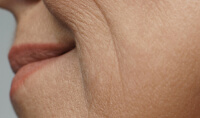 Loss of Skin Elasticity