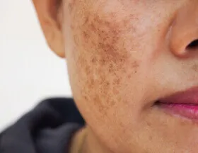 spot cream for melasma treatment