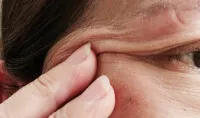 Menopausal Skin