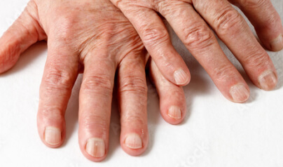 Nail Changes