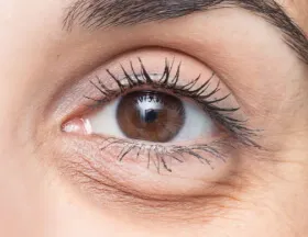 Puffiness