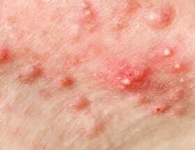 Pustules