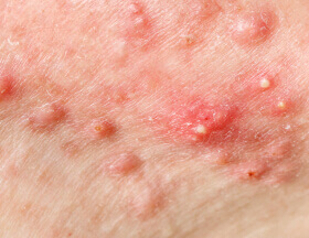 Pustules