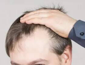 Receding Hairline (Men)