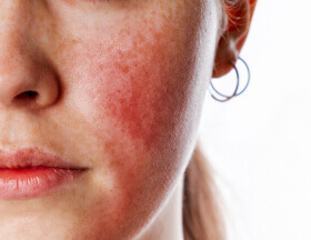 Skin Redness