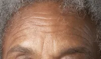 Skin Aging