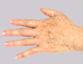 Dark spot remover for body