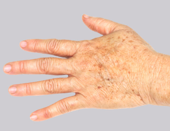 Sun/Age Spots (Body)