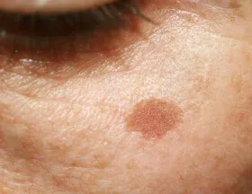 spot cream for sun spots and aging