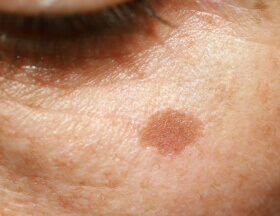 Sun/Age Spots (Face)