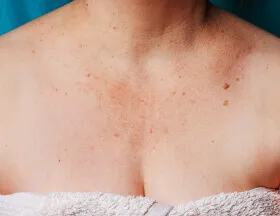 Sun/Age Spots (Neck/Chest)