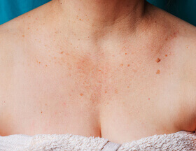 Sun/Age Spots (Neck/Chest)