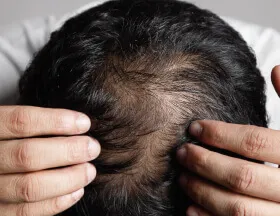 Thinning (Men)