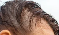 Thinning (Women)