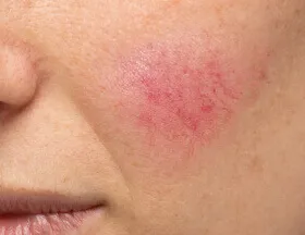 Visible Blood Vessels