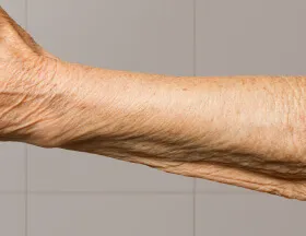 Wrinkles (Body)