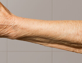 Wrinkles (Body)