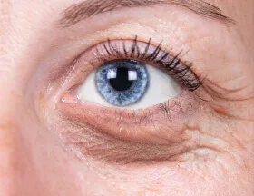 Wrinkles (Eyes)