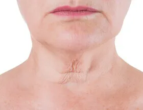 Wrinkles (Neck/Chest)