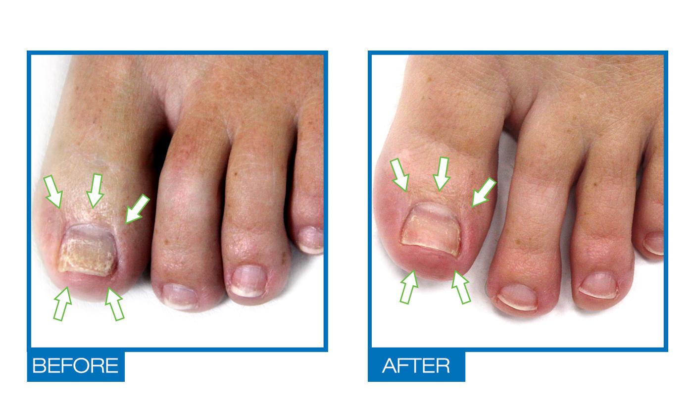 Omiera Labs Podiazole Nail Fungus Treatment, Fungal Nail Treatment, Toenail Fungus Treatment, Anti Fungal Nail Treatment - image 2