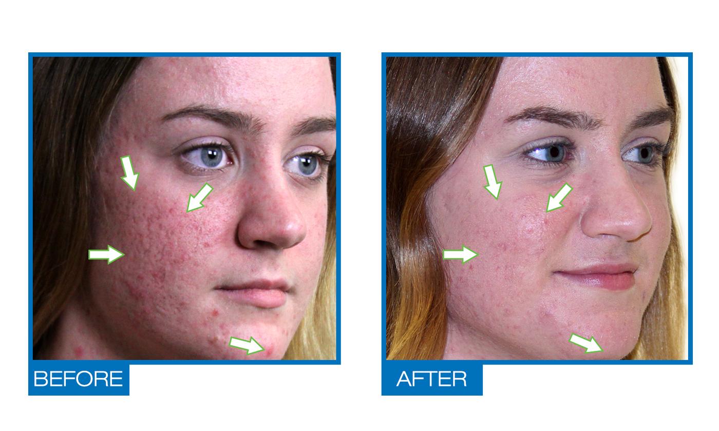 Omiera Labs Acdue Fast Acting Acne, Acne Scars, Blackheads, and Dark Spots Cream - image 2